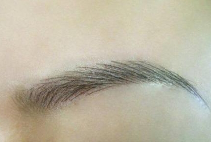 南方醫(yī)院陳兵拉皮手術(shù)真的值得選擇嗎？