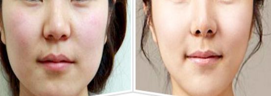 崔寓植鼻子效果如何？這個(gè)案例真實(shí)又自然！