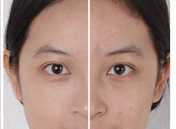 上海華美整形醫(yī)院展示用面部脂肪填充為您帶來全新視角