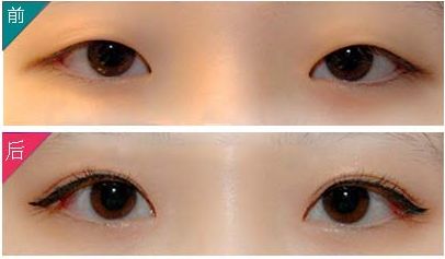 九院朱海男雙眼皮手術(shù)效果與價(jià)格一覽，了解最新資訊！