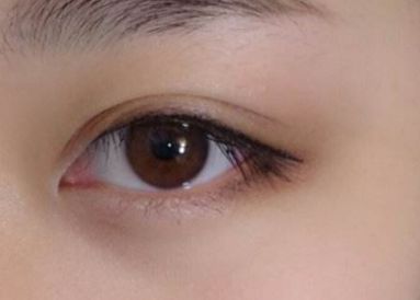 重慶2023年雙眼皮醫(yī)生：吳小樓、曹陽、何勝旗醫(yī)術(shù)對比