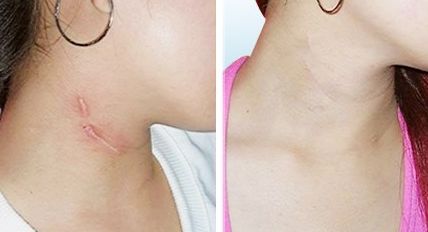 蘭州亞韓雙眼皮整形費(fèi)用一覽，談?wù)勈中g(shù)技巧與費(fèi)用