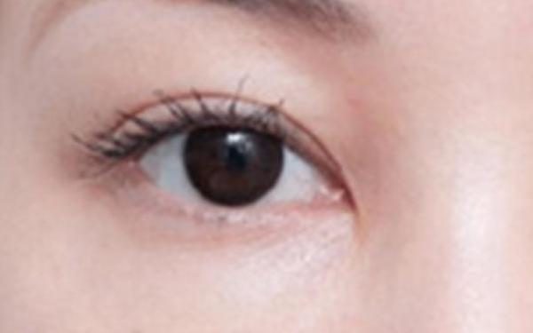 博愛醫(yī)院的雙眼皮效果如何？賈維順、許國明醫(yī)生資歷詳解