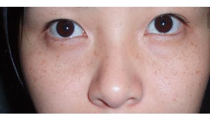 張恒術(shù)雙眼皮手術(shù)80天后效果揭曉，驚喜呈現(xiàn)！