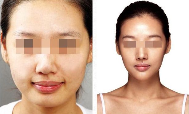 武漢恩娜整形中心：解讀雙眼皮手術(shù)全攻略，案例展示讓你真實(shí)了解效果！