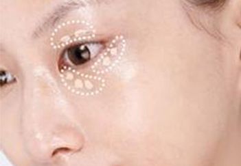 杭州葉秀娣做雙眼皮具體效果如何？專家實(shí)踐案例發(fā)布