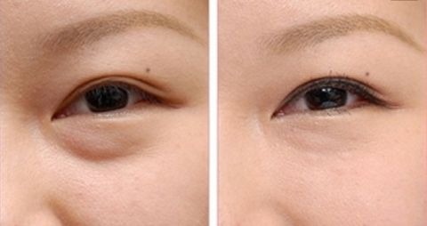 成都李烈療法注脂面部效果令人驚嘆！實例揭秘