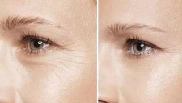 徐州二院哪位醫(yī)師擅長(zhǎng)雙眼皮手術(shù)？權(quán)威推薦榜單+手術(shù)費(fèi)用明細(xì)參考