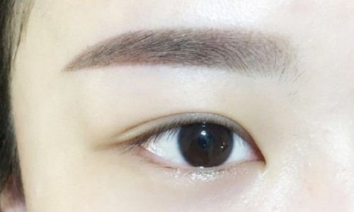 袁斯明醫(yī)生手術(shù)等待時(shí)間？術(shù)后恢復(fù)效果如何？眼部整容40天現(xiàn)圖曝光！