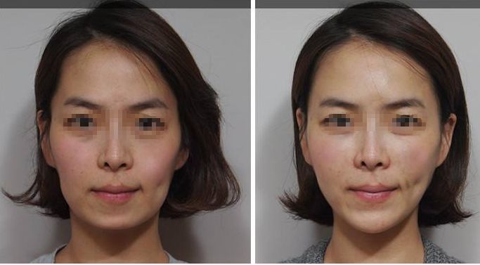 深圳頂級(jí)乳房整形專(zhuān)家團(tuán)隊(duì)？權(quán)威醫(yī)院解答哪家三甲醫(yī)院最適合隆胸