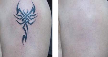 宋建星吸脂修復(fù)效果好嗎？吸脂修復(fù)宋建星技術(shù)如何？