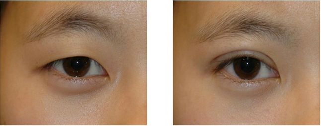 四川省人民醫(yī)院盛陽醫(yī)生綜合評(píng)價(jià)及吸脂手術(shù)詳解！