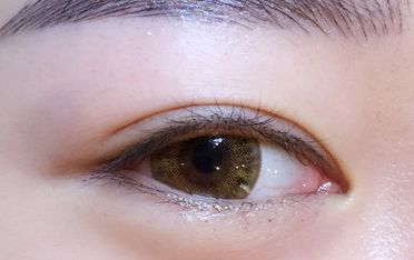 鄒翀，這一雙眼皮技術(shù)，近期有所革新