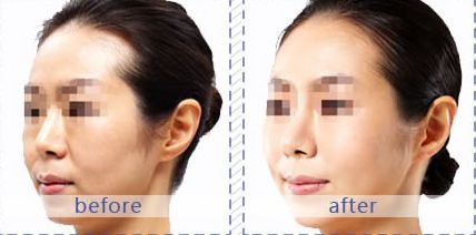 南京脂肪填充整形醫(yī)院推薦，蘇王、維多利亞和康美三家不容錯(cuò)過(guò)的選擇