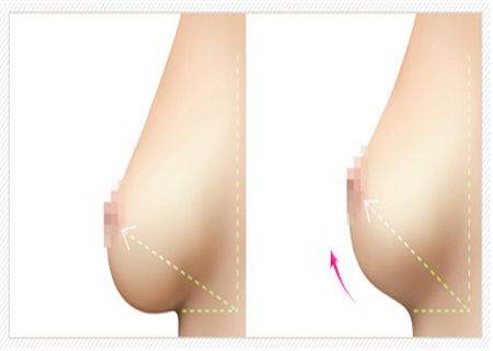 哈爾濱醫(yī)大一院乳房隆胸技藝揭秘！最新案例驚艷發(fā)布