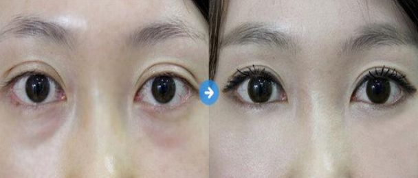 盤(pán)點(diǎn)北京7大值得信賴(lài)的開(kāi)眼角整形醫(yī)生