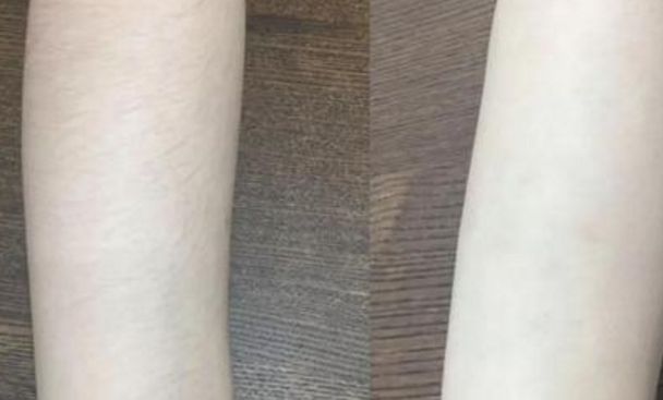 宜賓第一人民醫(yī)院的無(wú)痛隆鼻案例分享及費(fèi)用公示