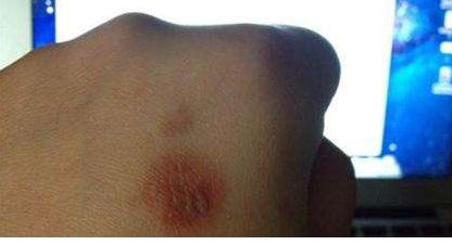 北京楊仁寶專業(yè)醫(yī)師分享雙眼皮手術(shù)技巧及成功案例