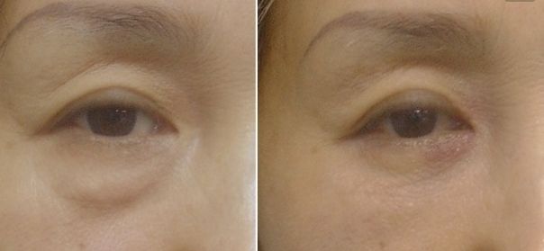 北京八大處趙延勇醫(yī)生的雙眼皮手術(shù)如何？了解醫(yī)院背景和手術(shù)案例。