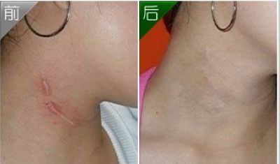 廣州隆胸手術(shù)費(fèi)用及案例分享，口碑如何？