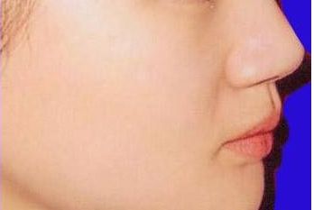 南京施爾美劉衛(wèi)豐鼻匠：獨(dú)具實(shí)力，成功案例揭秘！