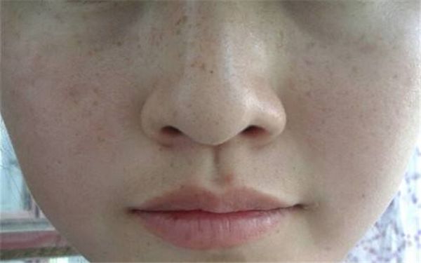 蘇州芘麗芙華美美容醫(yī)院耳軟骨整形效果和收費詳解