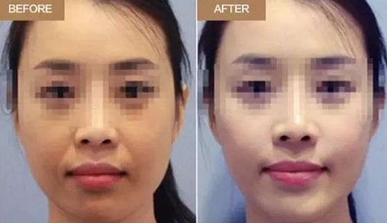 廈門五家口碑佳的隆鼻醫(yī)院，實力皆不俗