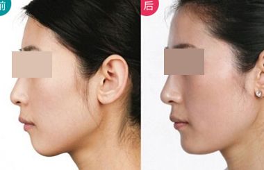 上海哪個(gè)醫(yī)生擅長(zhǎng)鼻翼縮??？2023年度網(wǎng)民口碑推薦醫(yī)生名冊(cè)曝光