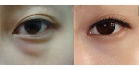 羅日云整容醫(yī)生的服務(wù)及費(fèi)用詳情，隱私公開！優(yōu)質(zhì)雙眼皮案例與收費(fèi)一覽供參考！