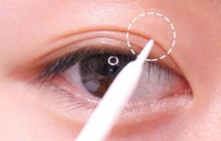 北京美聯(lián)臣路世敏醫(yī)生幫你告別歲月痕跡！除皺案例分享！