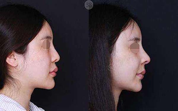 重慶美萊整形四月特惠，是不是只需6000元即可減400元？雙眼皮可以實現(xiàn)嗎？