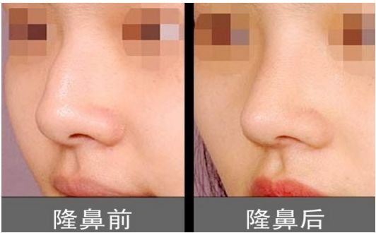 上海柴云醫(yī)生雙眼整形效果完美！手術(shù)前后真實照片呈現(xiàn)出專業(yè)水平