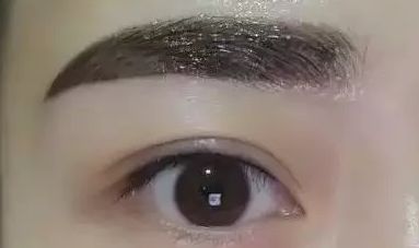 浙二醫(yī)院葉娟為患者打造完美雙眼皮，成就精致美眸