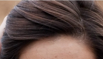 南昌二附院整形科眼袋抽脂效果好嗎？值得醫(yī)生推薦嗎？