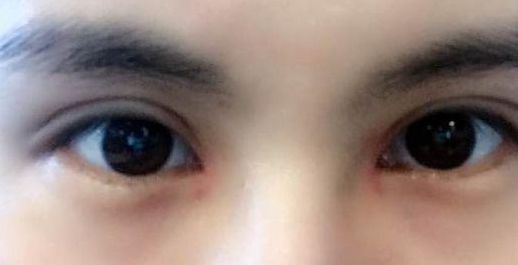 張盈帆雙眼皮手術(shù)費(fèi)用評估！專家點(diǎn)評及最新報(bào)價(jià)公布！