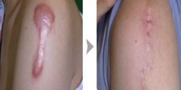 武漢仁愛時(shí)光醫(yī)療美容醫(yī)院優(yōu)質(zhì)案例分享，自體脂肪隆胸效果如何？