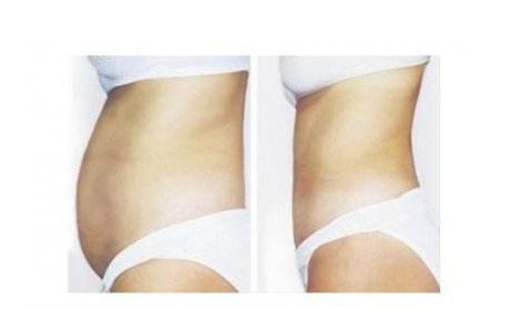 寧波哪家醫(yī)院的拉皮手術(shù)技術(shù)值得信賴？值得關(guān)注的醫(yī)院排行榜推薦