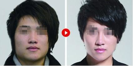 廣州美萊田躍平醫(yī)生為您帶來的鼻部整形體驗(yàn)案例曝光