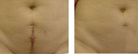 重慶張恒術(shù)進行雙眼皮手術(shù)，醫(yī)生實力以及成功案例展示