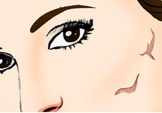 張曉建拉皮的效果好不好？如何評價？