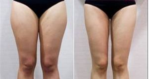 浙江杭州有沒有靠譜的鵬愛整形醫(yī)院？頂尖專家現(xiàn)身說法！