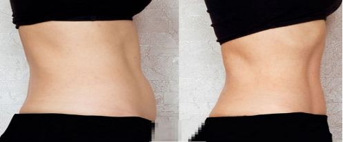 英諾小棕瓶的微針和滾針，如何選擇？英諾小棕瓶反黑效果需要多久呢？