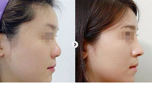 揭秘廣州整容界很受推崇的隆鼻醫(yī)生排行榜！TOP10豪華陣容對決，尊貴專家非一般醫(yī)師！