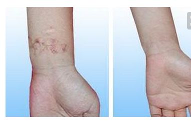 燕化醫(yī)院整形美容科：雙眼皮矯正價(jià)格及效果分享