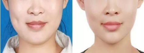 北京久經(jīng)考驗(yàn)的八大處雙眼皮醫(yī)生，蔣海越和馬繼光的美譽(yù)妙不可言