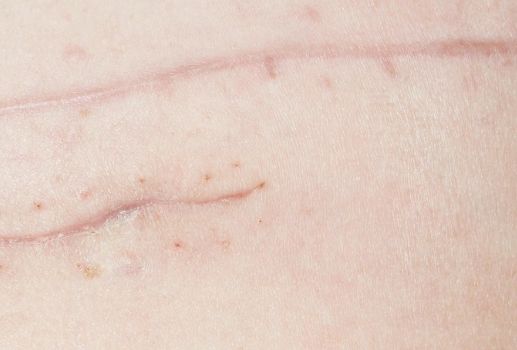 桂林華美醫(yī)院：胡凱鼻子整形前后效果大揭秘！看圖真相引人矚目