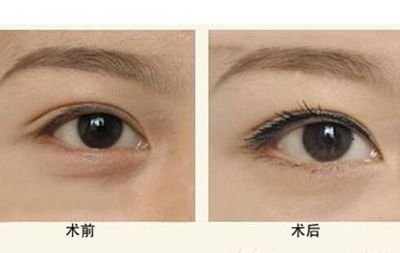 嘉興哪家醫(yī)院可以消除木偶紋效果好？