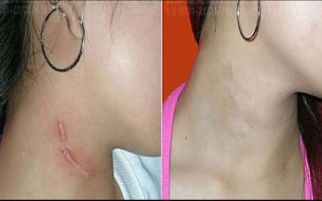 北京首都整形醫(yī)院雙眼皮修復(fù)效果如何？詳細案例揭秘