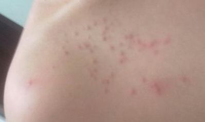 北京萬達行姜洪濤醫(yī)生最新開眼角效果分享！2023年價格公布！