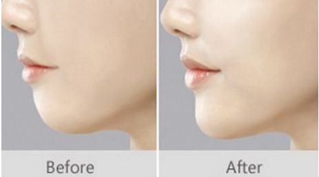 上海唇裂修復的五家知名醫(yī)院，人氣爆棚，不容錯過！